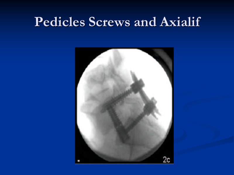 Pedicles Screws and Axialif